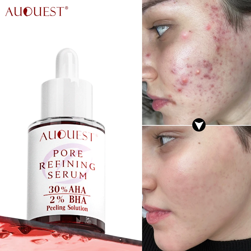 Acne Treatment Facial Serum Pore Shrinking Skin Care Against Face Acne Pimple Sp